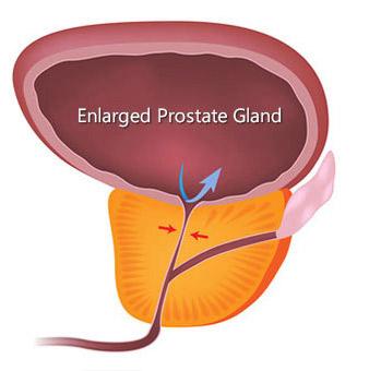 Enlarged Prostate Gland