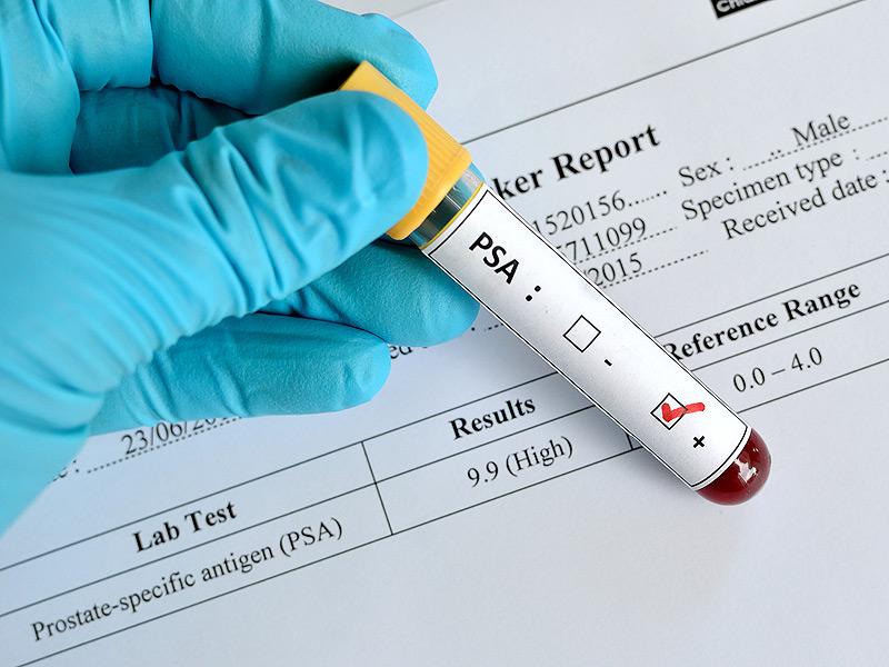 Prostate Specific Antigen